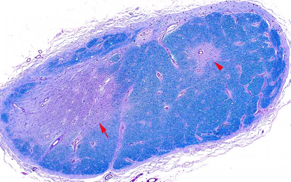 3B2 MS,optic nerve (Case 3) LFB-PAS 4X copy