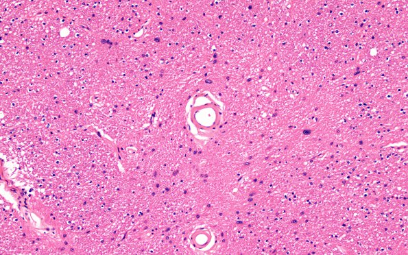 3C1 MS,optic nerve (Case 3) H&E 20X