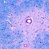 3C2 MS,optic nerve (Case 3) LFB-PAS 20X