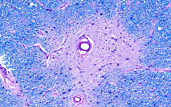 3C2 MS,optic nerve (Case 3) LFB-PAS 20X