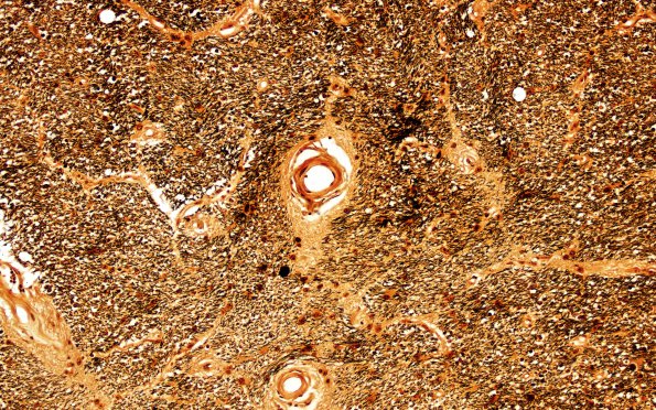 3C3 MS,optic nerve (Case 3) Biels 20X