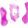 4B1 MS (Case 4) Optic nerves H&E copy