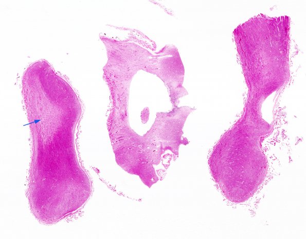 4B1 MS (Case 4) Optic nerves H&E copy