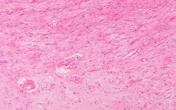 4B2 MS, optic nerve (Case 4) H&E 10X