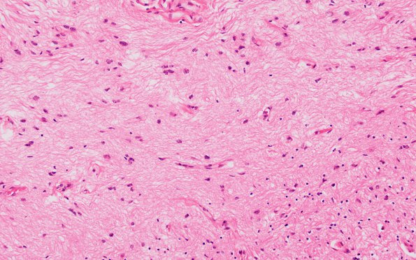 4B3 MS, optic nerve (Case 4) H&E 20X