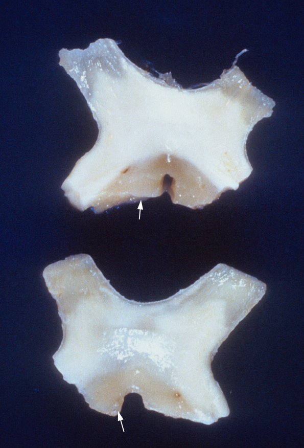 5A1 Multiple Sclerosis (WUMS Case) gross 8 (optic nerves) copy