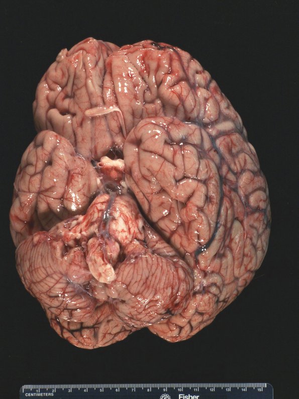 6A1 MS, optic nerve (Case 6) Gross 1