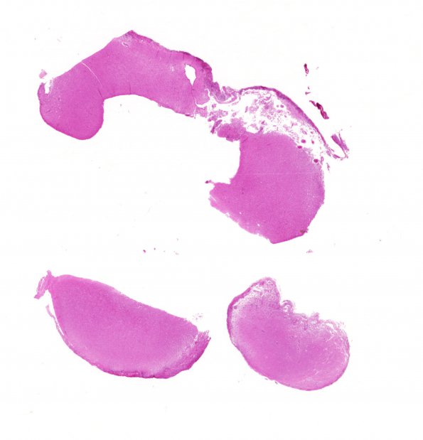 6B1 MS, optic nerves-chiasm (Case 6) N19 H&E WM