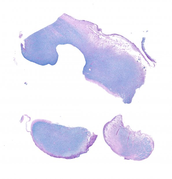 6B2 MS, optic nerves-chiasm (Case 6) N19 LFB-PAS WM