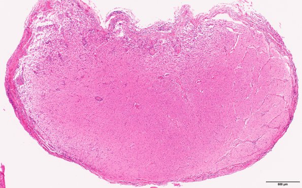 6C1 MS, optic nerve (Case 6) N19 H&E 4X