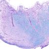 6C2 MS, optic nerve (Case 6) N19 LFB-PAS 4X