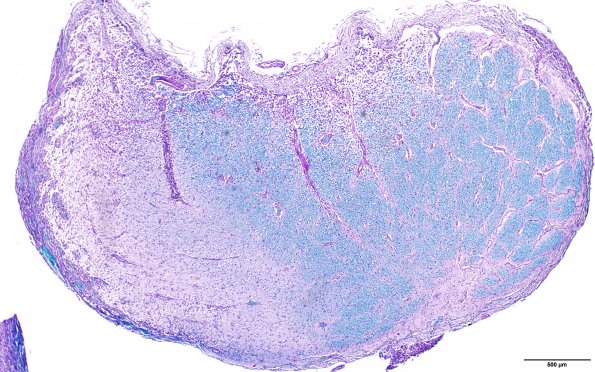 6C2 MS, optic nerve (Case 6) N19 LFB-PAS 4X