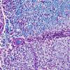 6D1 MS, optic nerve (Case 6) N19 LFB-PAS 20X