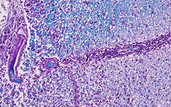 6D1 MS, optic nerve (Case 6) N19 LFB-PAS 20X