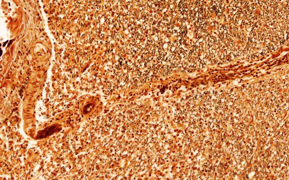 6D2 MS, optic nerve (Case 6) N19 Biels 20X