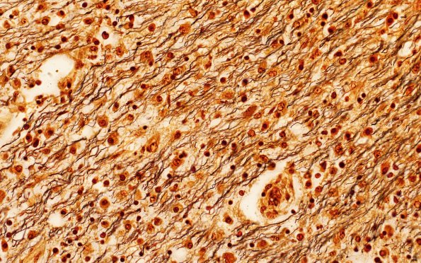 6D3 MS, optic nerve (Case 6) N19 Biels 40X chiasm