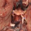 7A1 MS, optic nerve (Case 7) copy copy