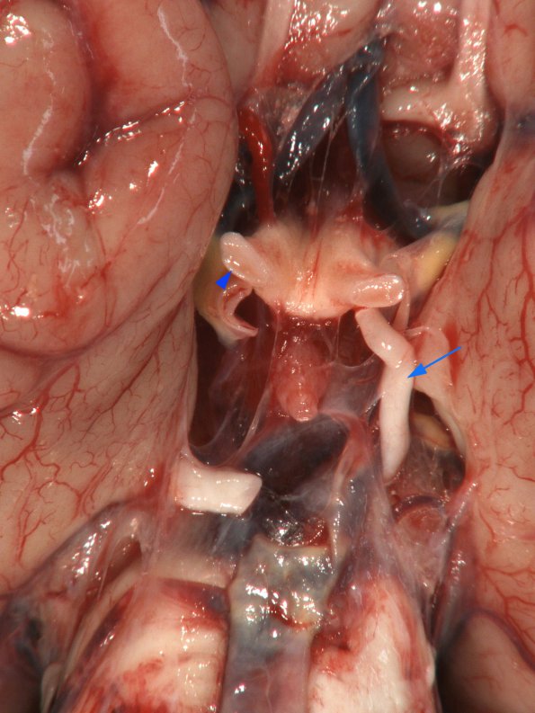 7A1 MS, optic nerve (Case 7) copy copy