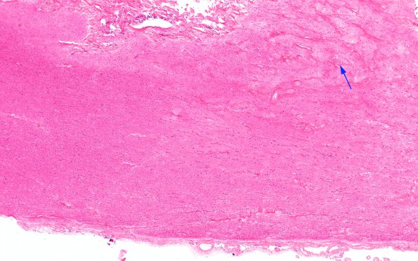 7B1 MS, optic nerve (Case 7) 4X copy