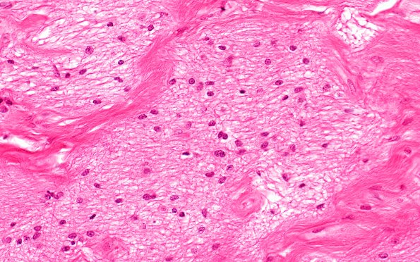 7B3 MS, optic nerve (Case 7) 40X 2