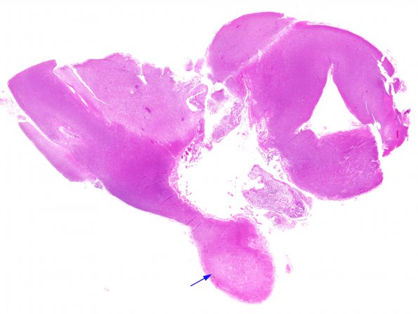 8A1 MS, Optic nerve (Case 8) N13 H&E WM copy