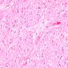 8B1 MS, optic nerve (Case 8) H&E 20X