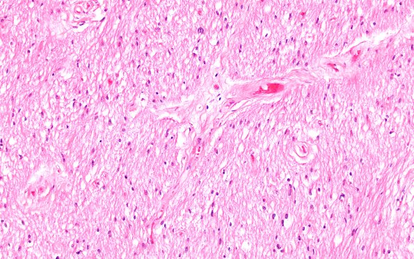 8B1 MS, optic nerve (Case 8) H&E 20X