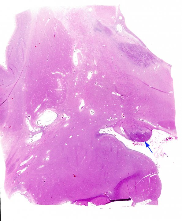 9A1 MS (Case 9) optic tract B9 H&E whole mount 2 copy