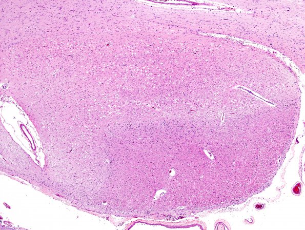 9A2 MS (Case 9) optic tract B9 2 H&E whole mount