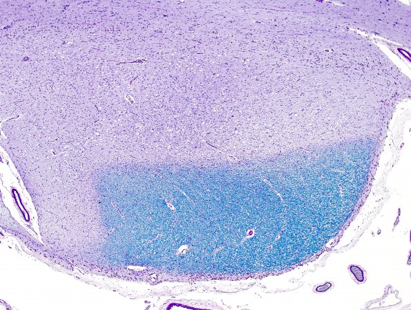 9B2 MS (Case 9) optic tract B9 2 LFB-PAS whole mount