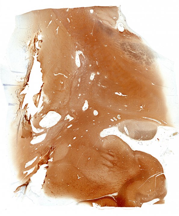 9C1 MS (Case 9) optic tract B9 NF whole mount