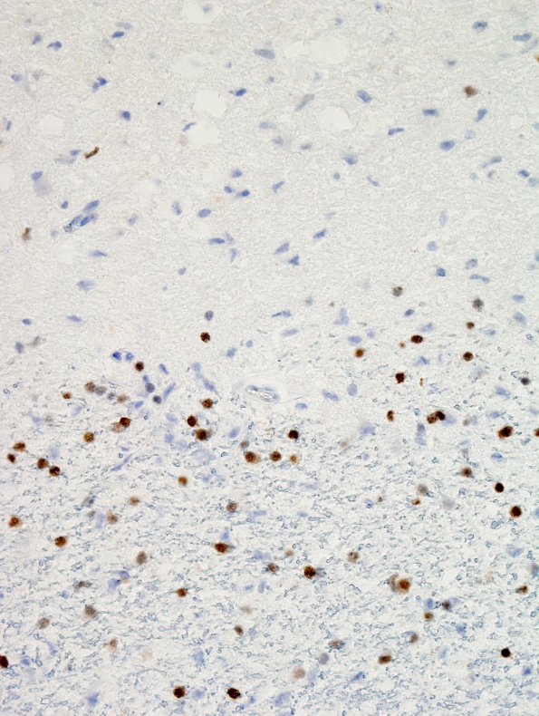9F2 MS (Case 9) brainstem-basal ganglia Olig 2 3