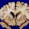 1A3 MS, Primary Progressive (PPMS) (Case 1)