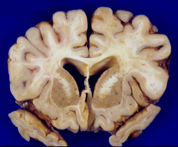 1A3 MS, Primary Progressive (PPMS) (Case 1)