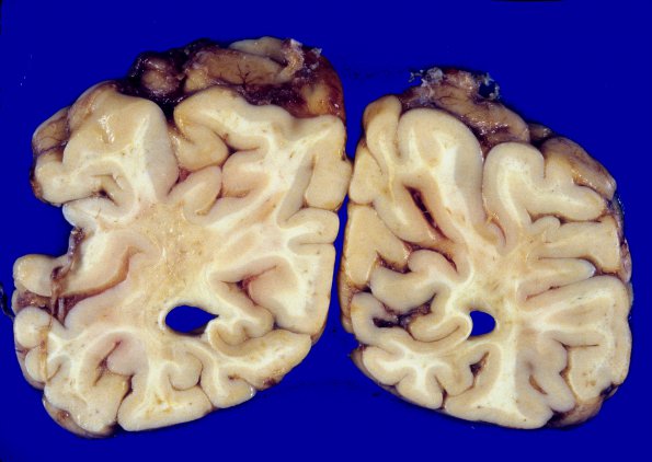 1A5 MS, Primary Progressive (PPMS) (Case 1)