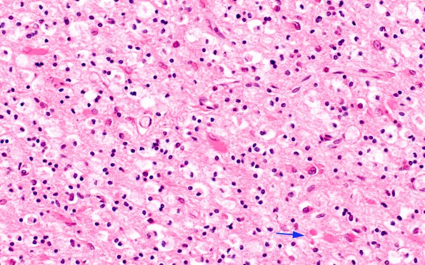 1B3 MS, Primary Progressive (PPMS) (Case 1) N11 H&E 40X copy