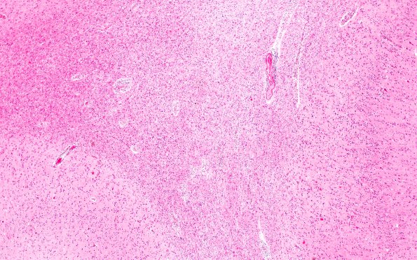 1C4 MS, Primary Progressive (PPMS) (Case 1) H&E  N1 4X