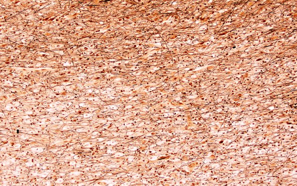 1D6 MS, Primary Progressive (PPMS) (Case 1) LFB-PAS N12 10X demyel area 3