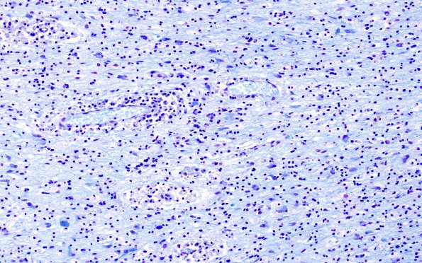 1D7 MS, Primary Progressive (PPMS) (Case 1) LFB-PAS N12 40X demyel area 4