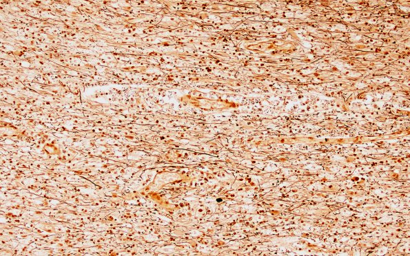 1D8 MS, Primary Progressive (PPMS) (Case 1) LFB-PAS N12 20X demyel area 2