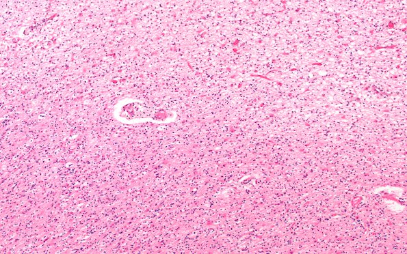 1F2 MS, Primary Progressive (PPMS) (Case 1) H&E N13 10X demyel area 1