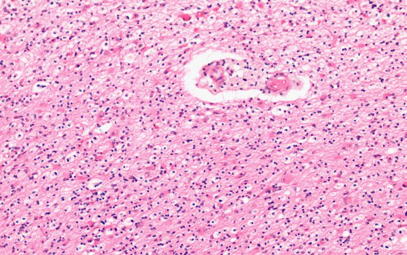 1F3 MS, Primary Progressive (PPMS) (Case 1) H&E N13 10X demyel area 2