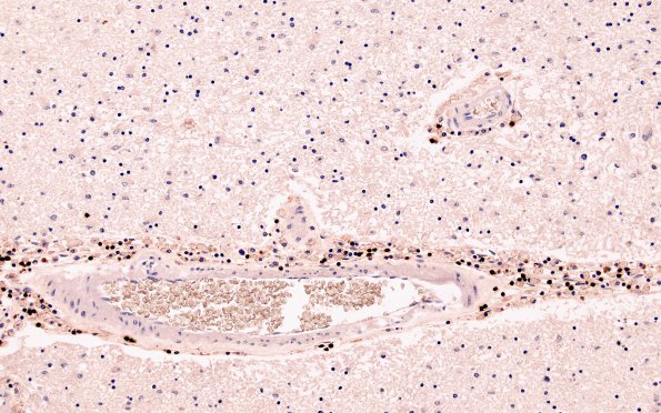 1F4 MS, Primary Progressive (PPMS) (Case 1) UCHL1 N13 10X demyel area 1