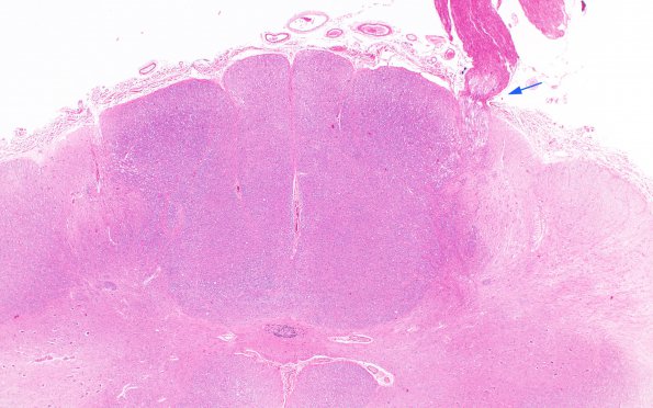 1A1 Schwannian Remyelination (Case 1) H&E 2X nl entry 1 copy