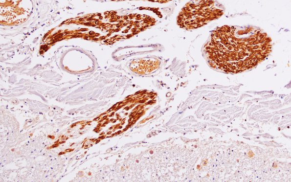 1A10 Schwannian Remyelination (Case 1) normal root exit zone Po 20X area B