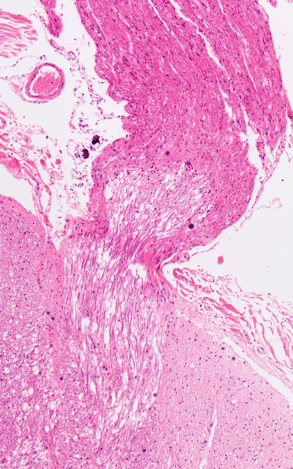 1A2 Schwannian Remyelination (Case 1) H&E 10X nl entry 1