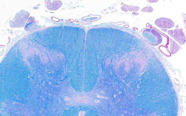 1A3 Glial Dome (Case 1A) LFB-PAS 2X