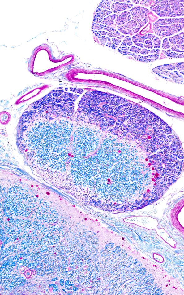 1A4 Glial Dome (Case 1A) LFB-PAS 10X