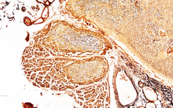 1A5 Glial Dome (Case 1A) Sevier-Munger 10X