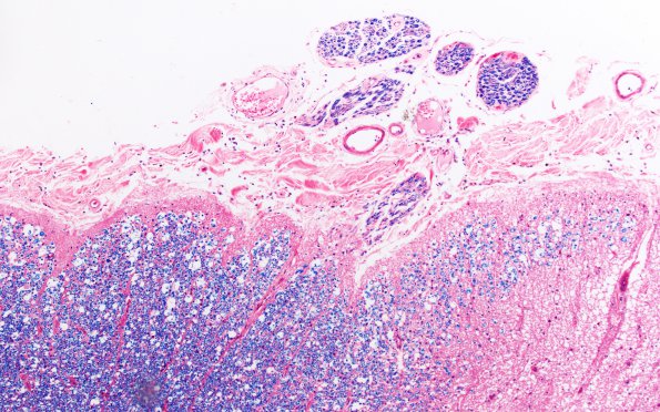 1A7 Schwannian Remyelination (Case 1) normal root exit zone Solochrome cyanine 10X